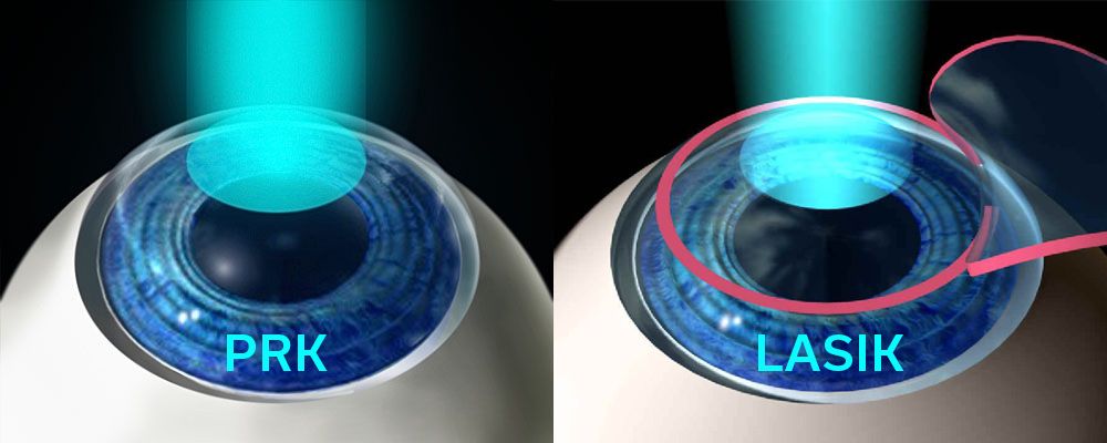 Lasik vs. PRK illustration