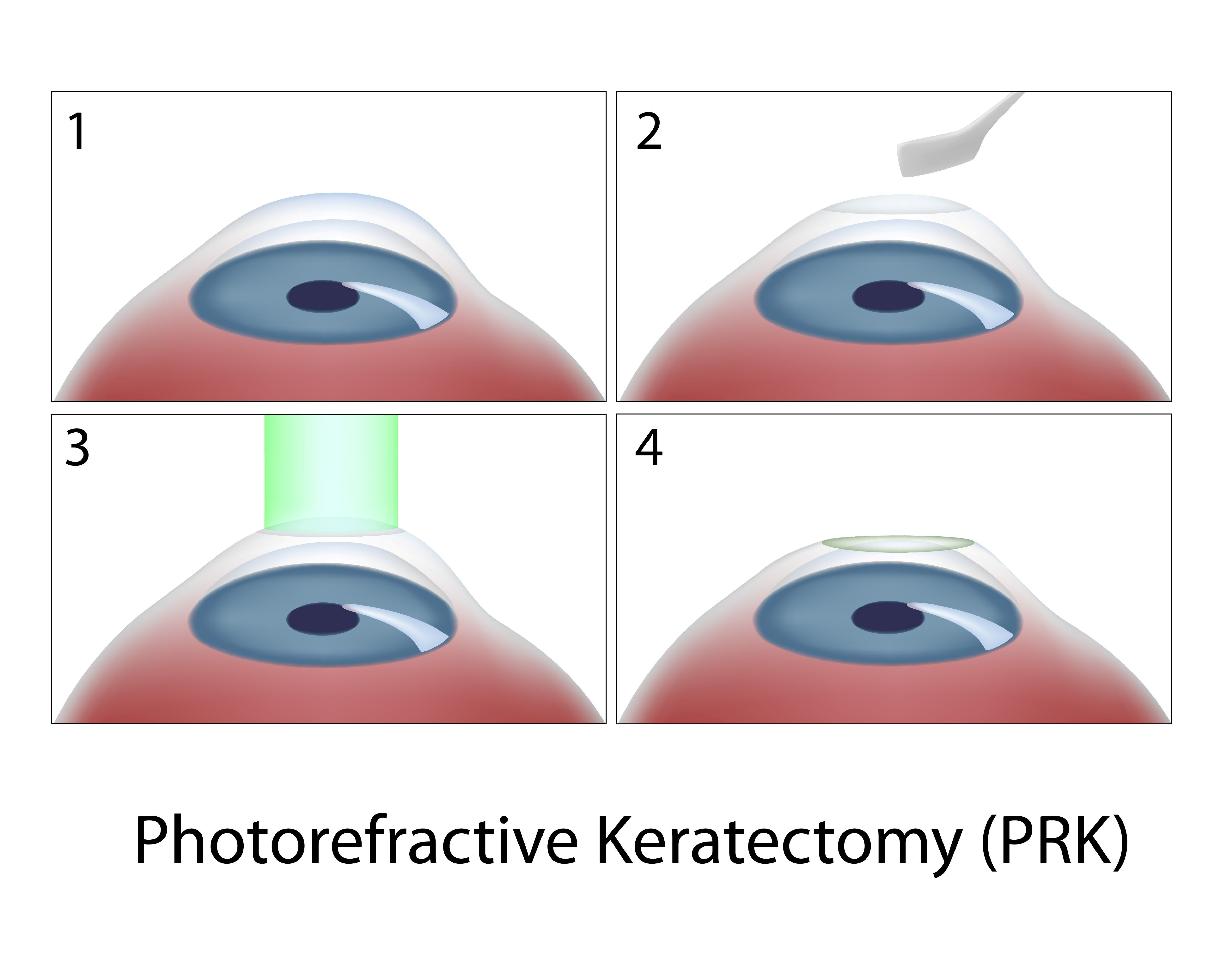Illustration showing stages of PRK eye treatment